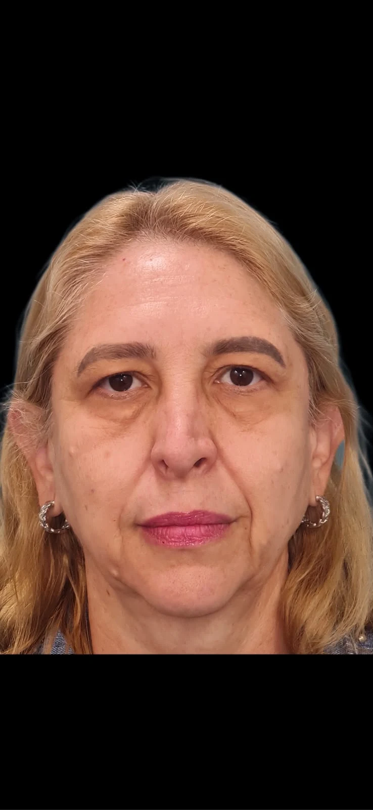 Fotografia clínica frontal do caso 4 de blefaroplastia, antes do procedimento.