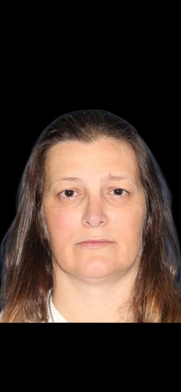 Fotografia clínica frontal do caso 5 de blefaroplastia, antes do procedimento.